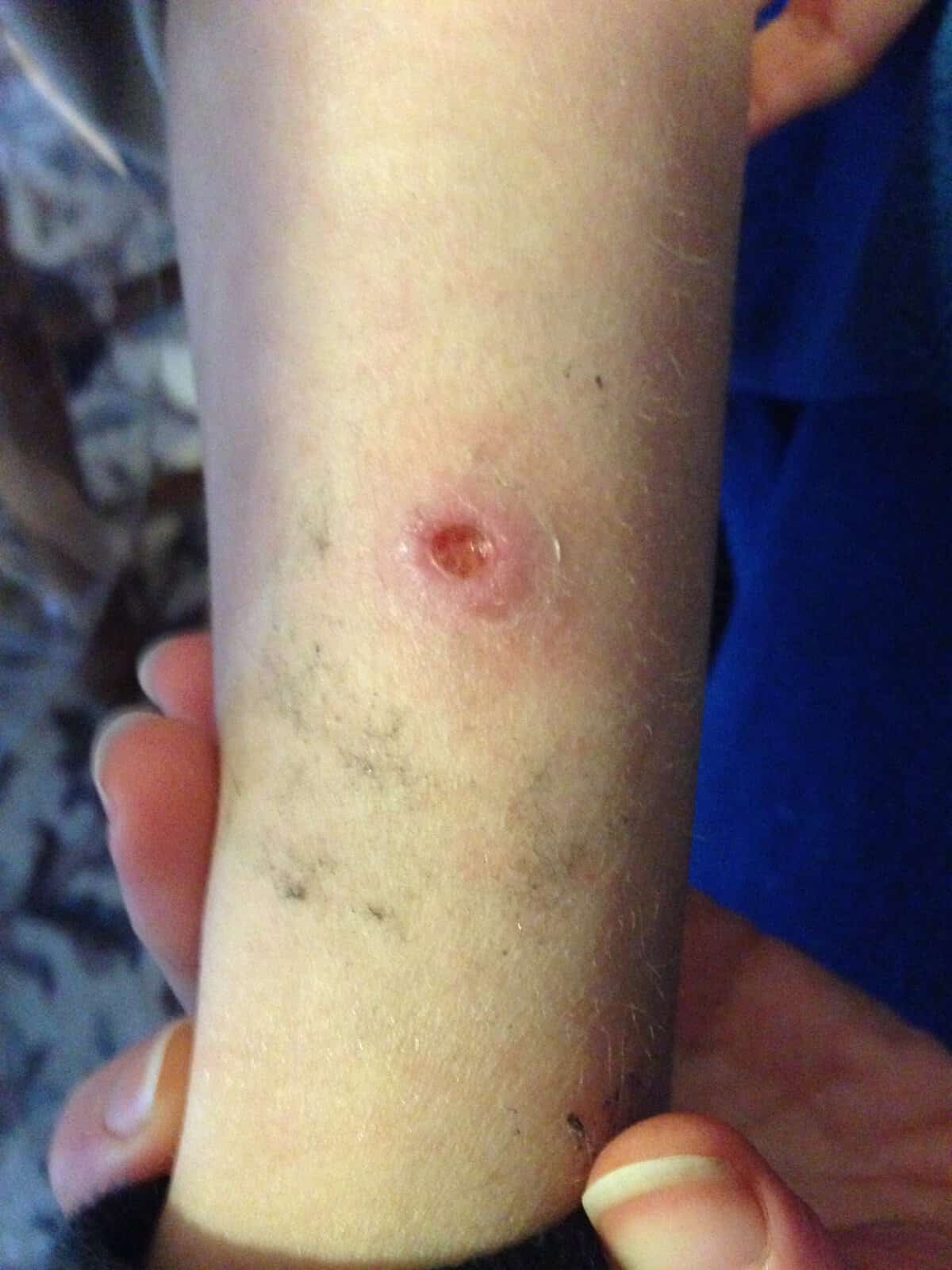 Brown Recluse Spider Bite! - Ridge Haven Homestead